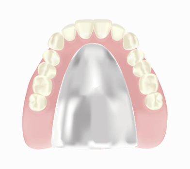 コバルトクロム床義歯