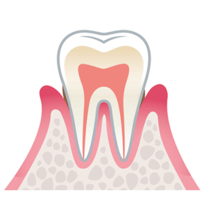 歯周炎（軽度）